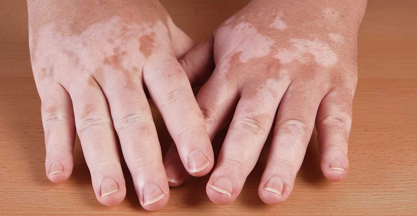 Causas del vitiligo y su relación con la diabetes mellitus tipo 1